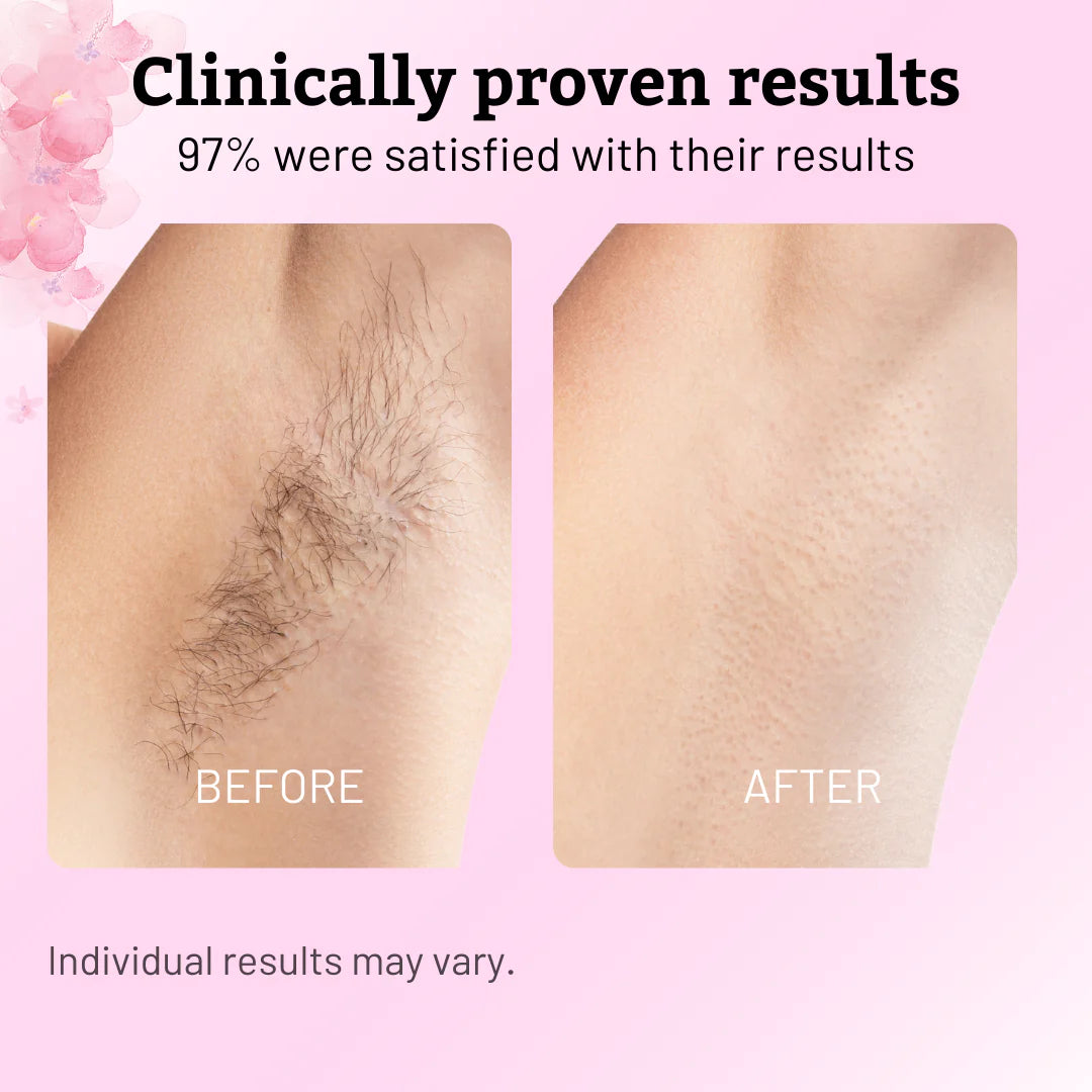 Cyperus Rotundus Oil for Hair Reduction